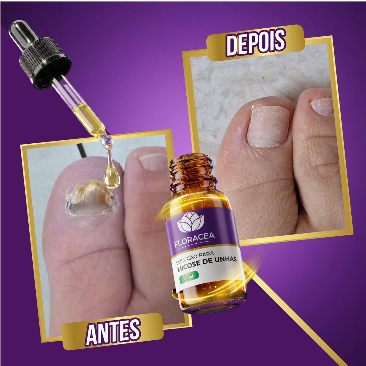 Solução de Micose 10ml